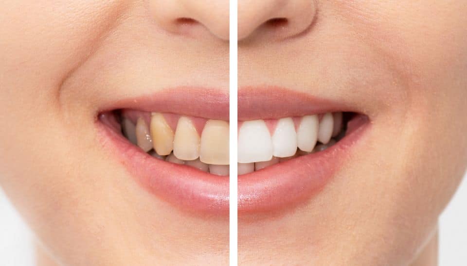 Stained teeth comparison