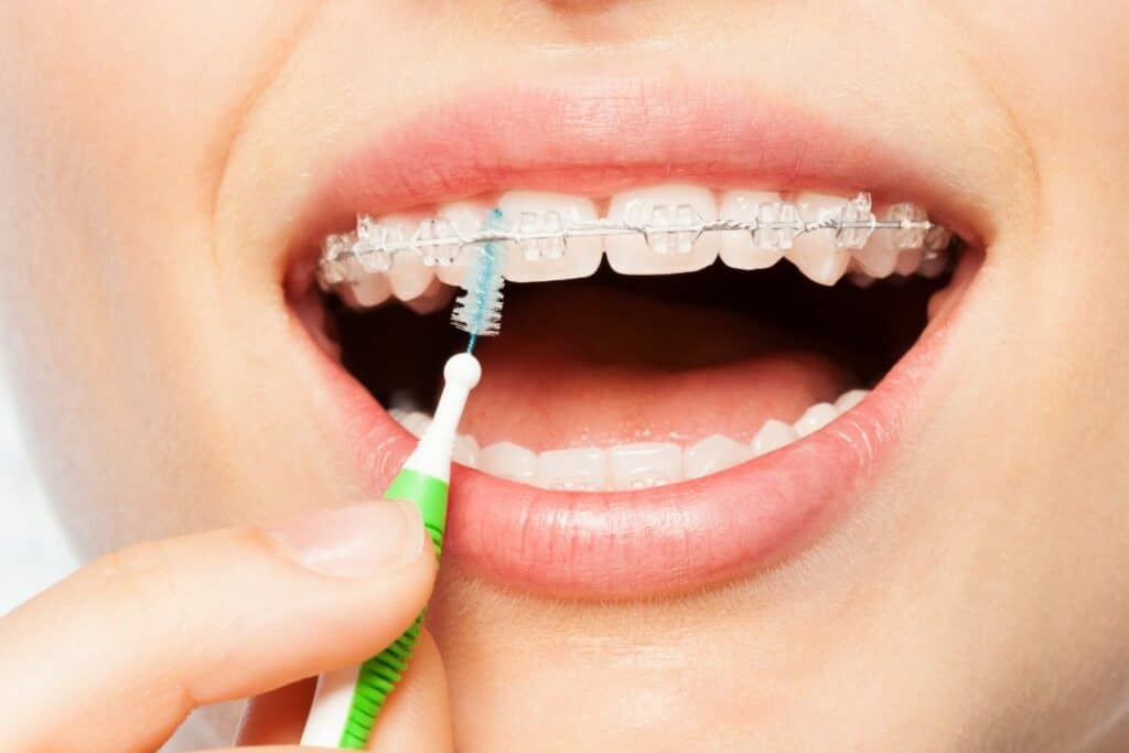 Using an interdental brush with a brace